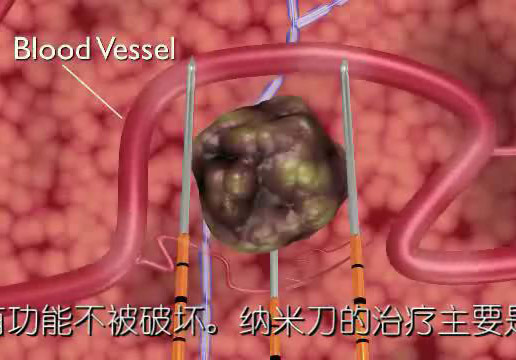 納米刀消融療法（IRE）